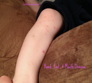 Hand, Foot, and Mouth Disease